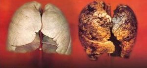 پنوموکونيوزيس آسم کارگران معدني